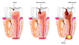 Tooth Decay and Cavities