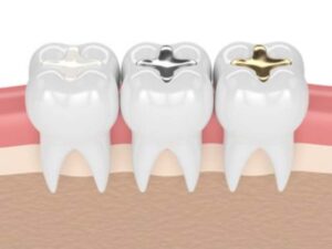 Fillings in tooth