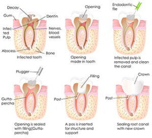 The Root Canal Procedure