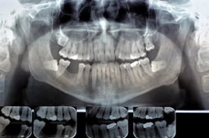 Digital X-ray of tooth