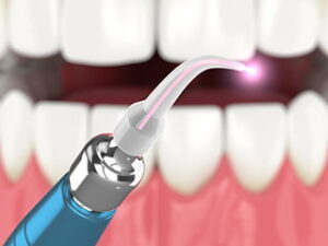 Dental Laser treatment