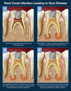 root canal infection graph