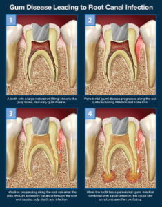 root canal infection graph