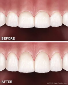 Before and after image of a teeth