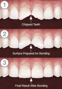 Image of types of teeth