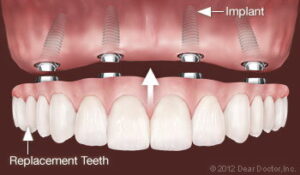 dental implants & Replacement