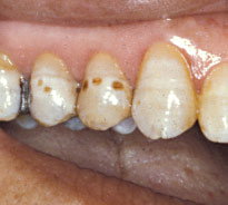 Fluorosis.