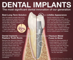 Dental Implants