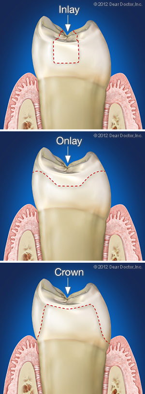 Inlay, Onlays and Crowns.