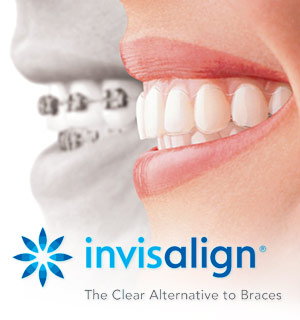 invisalign teeth