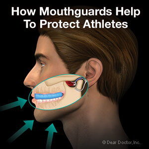 Mouthgaurads