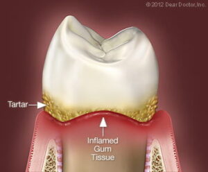 Tooth Treatment