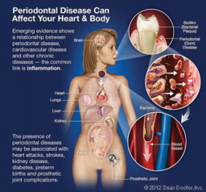 Periodontal disease chart