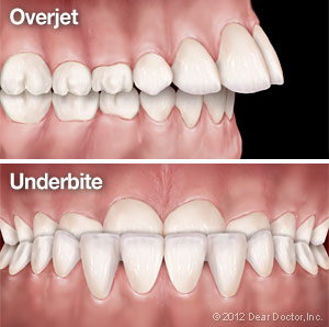 tooth comparision