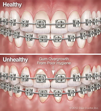 tooth comparision