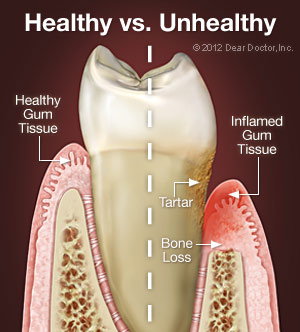 tooth healthy and unhealthy explanation