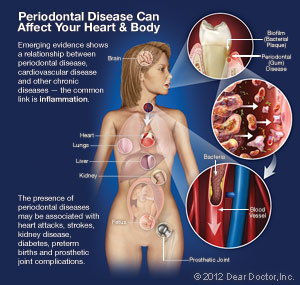 Periodontal disease explanation 