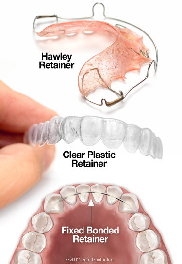 teeth braces explanation