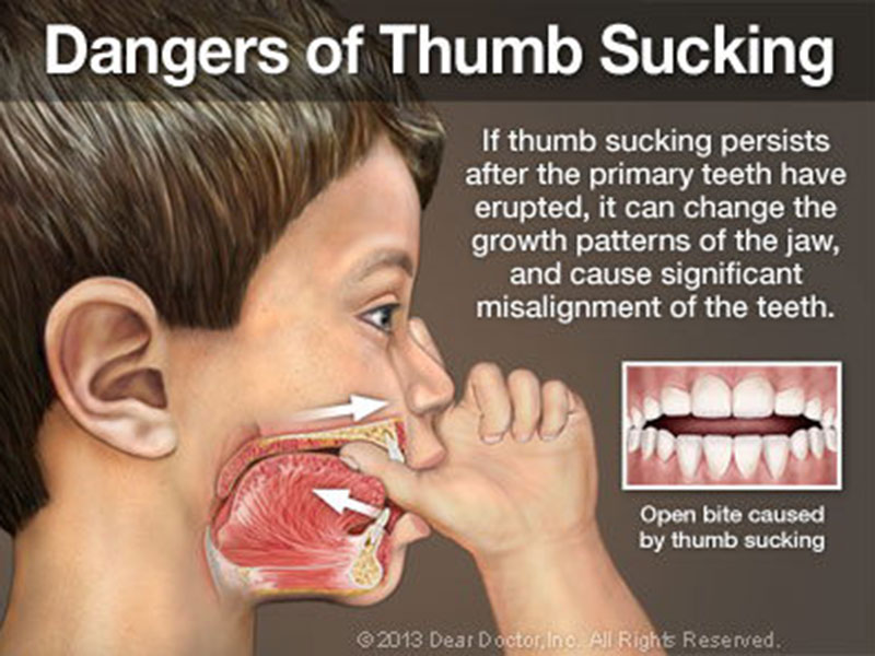 Dangers of Thumb Sucking