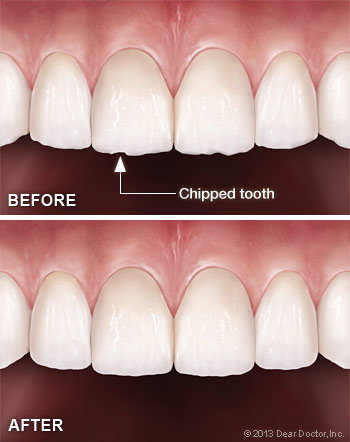 Before and after of the mouth