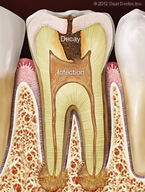 Tooth Decaying