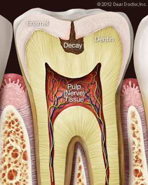 Tooth Decaying