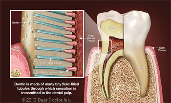 Cavity In tooth