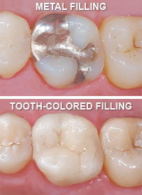 Tooth Filling