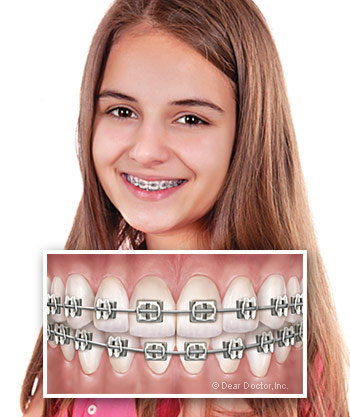 Children's wearing braces