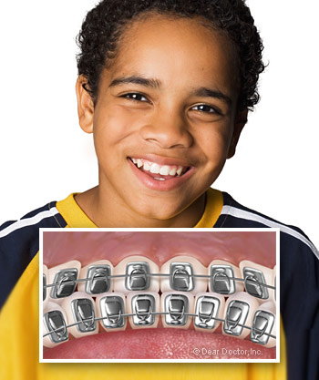 Children's wearing braces