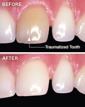 Before and after of teeth cleaning