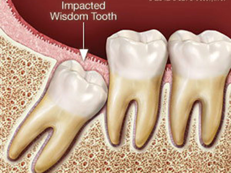 Wisdom tooth