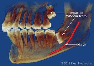 Wisdom tooth x-ray