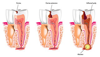 Stages of tooth decaying
