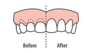 Before and after image of a teeth