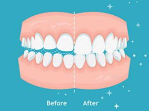 teeth before and after