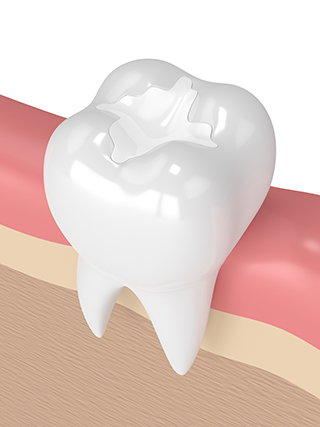 Filled tooth