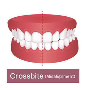 Crossbite Missalignment