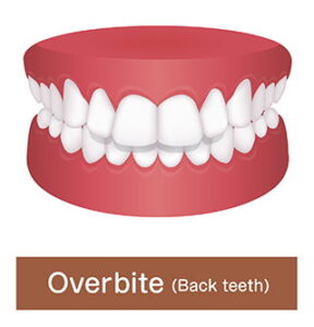 Overbite