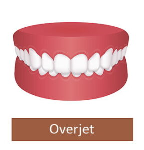 Overjet