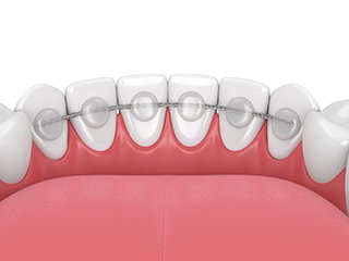 teeth bracing