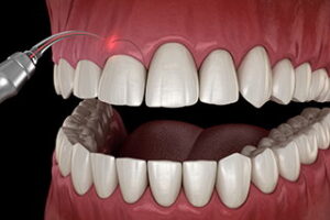 Laser treatment on teeth