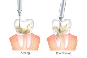 Tooth Treatment
