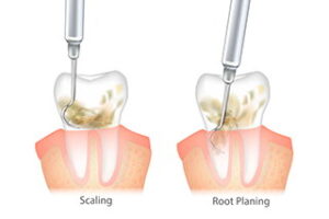 Tooth Treatment