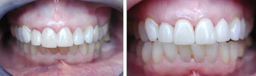 Anterior All Ceramic Crowns