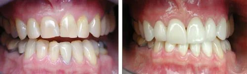 All Ceramic Crowns Upper and Lower