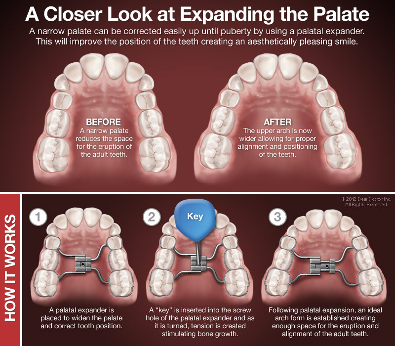 How palatal expanders work.