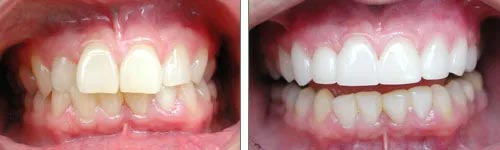 Porcelain Veneers